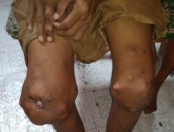 Hengky, Penderita Gout Kronis Di Tanah Datar, Butuh Penanganan Khusus