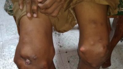 Hengky, Penderita Gout Kronis Di Tanah Datar, Butuh Penanganan Khusus