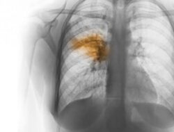 Pneumonia Menjadi Penyakit yang Berbahaya, Kenali Gejalanya Pada Anak !